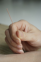 acupuncture needle being inserted - Ellery Chua