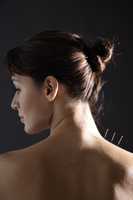 acupuncture needles in woman's neck - Nugene Chiang